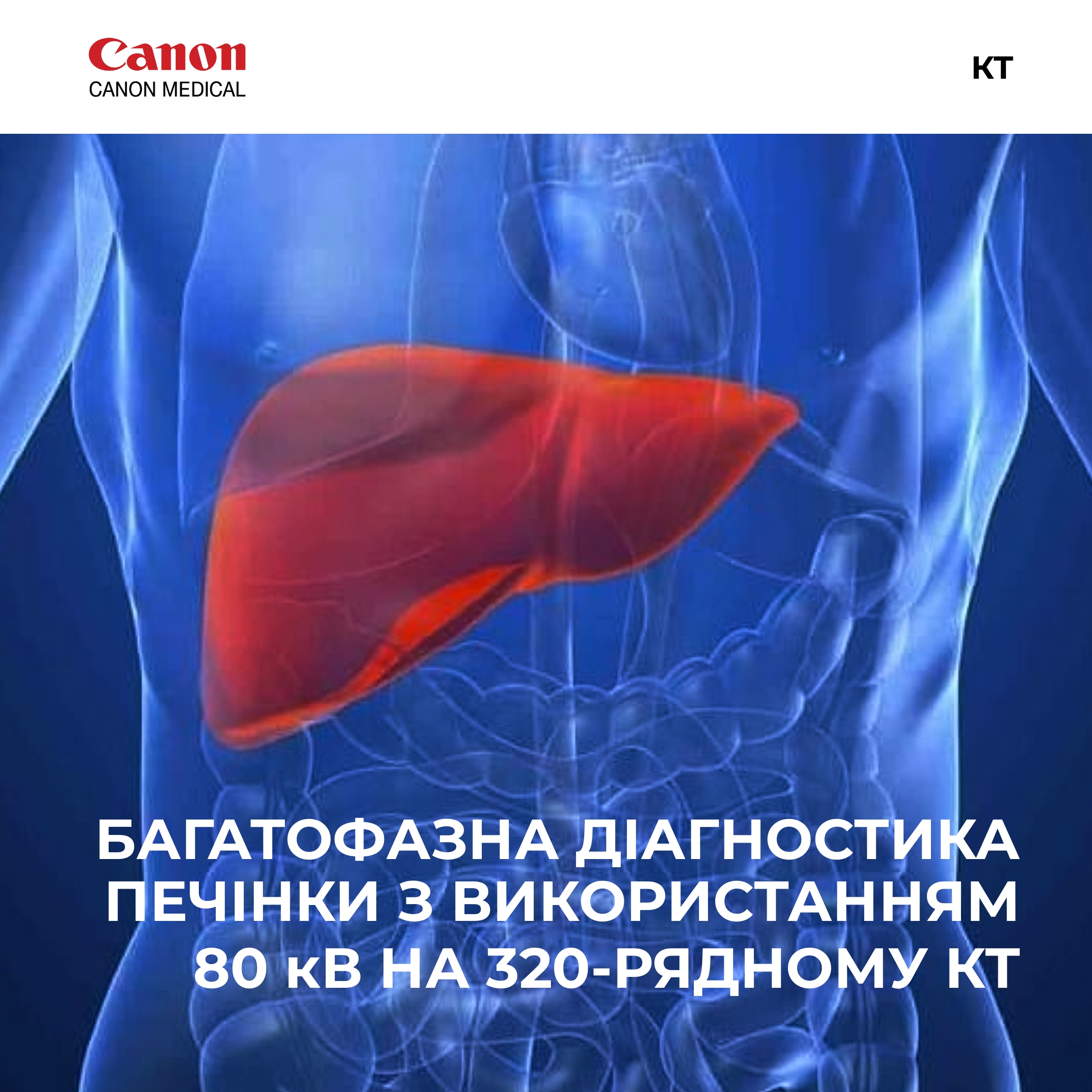Багатофазна діагностика печінки з використанням 80 кВ на 320-рядному КТ.